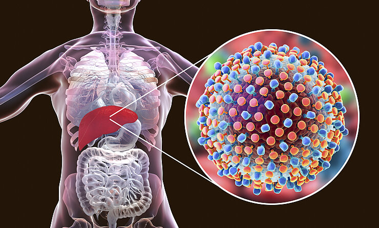 Graphic - Hepatitis C virus in liver