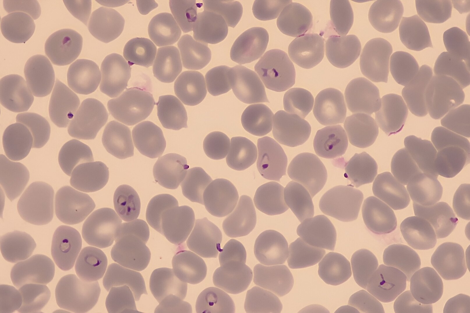 Light microscopy of red blood cells, some are infected with Plasmodium