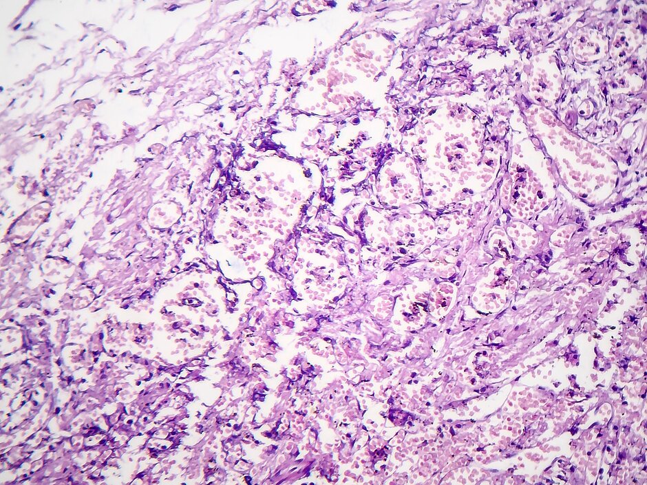 Histological examination of tissue pneumonia