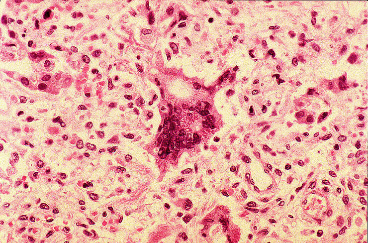 Riesenzelle bei einer Masern-Pneumonie (Lungenentzündung); Feingeweblicher Schnitt
