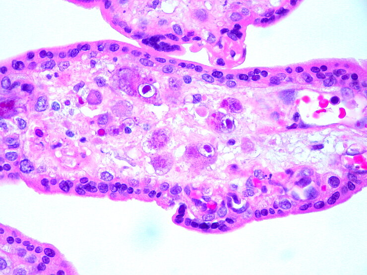 Tissue section of a placenta in which infection with cytomegalovirus has caused placentitis.