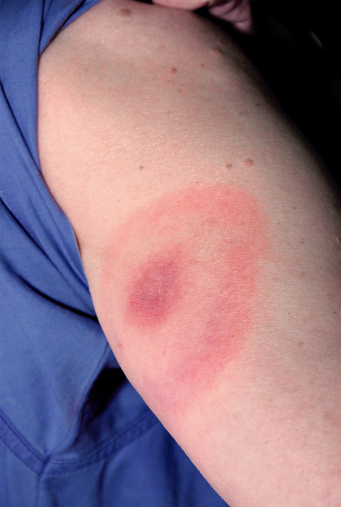 Arm with erythema due to Borrelia infection