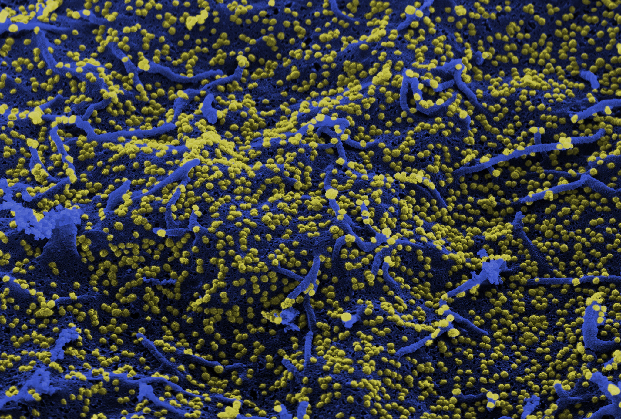 Vero6 cells (renal epithelial cells) infected with SARS-CoV-2