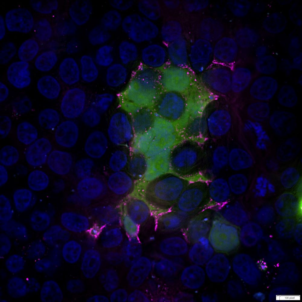 Mikroskopisches Bild von mit RSV infizierten Zellen. Grün: Mit GFP markiertes RSV-F-Protein im Zytoplasma der Zellen, Magenta: RSV-F-Protein, Blau: Zellkerne.